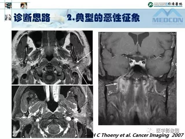 【PPT】腮腺肿瘤的MR诊断思路