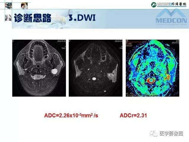 【PPT】腮腺肿瘤的MR诊断思路