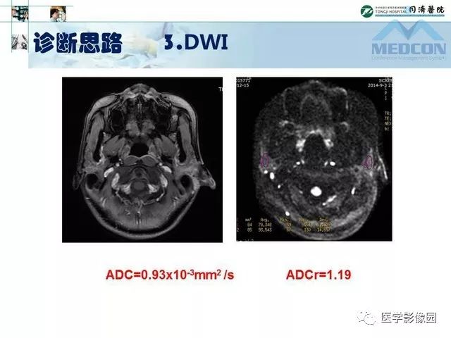 【PPT】腮腺肿瘤的MR诊断思路