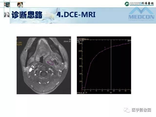 【PPT】腮腺肿瘤的MR诊断思路