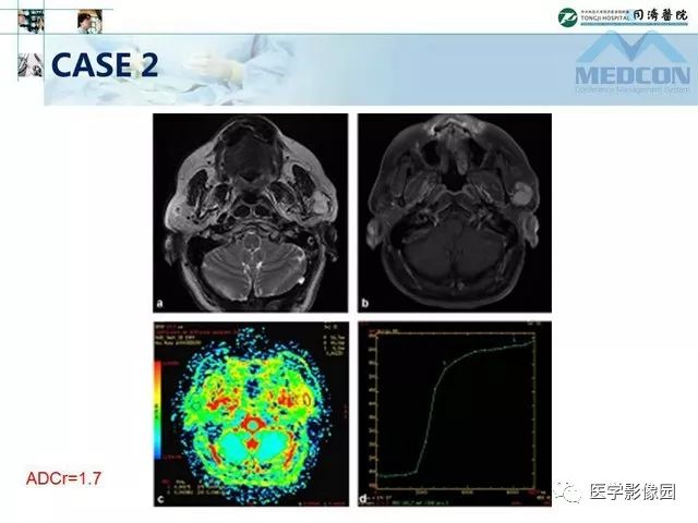 【PPT】腮腺肿瘤的MR诊断思路