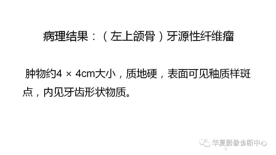 【病例】牙源性纤维瘤1例CT影像表现