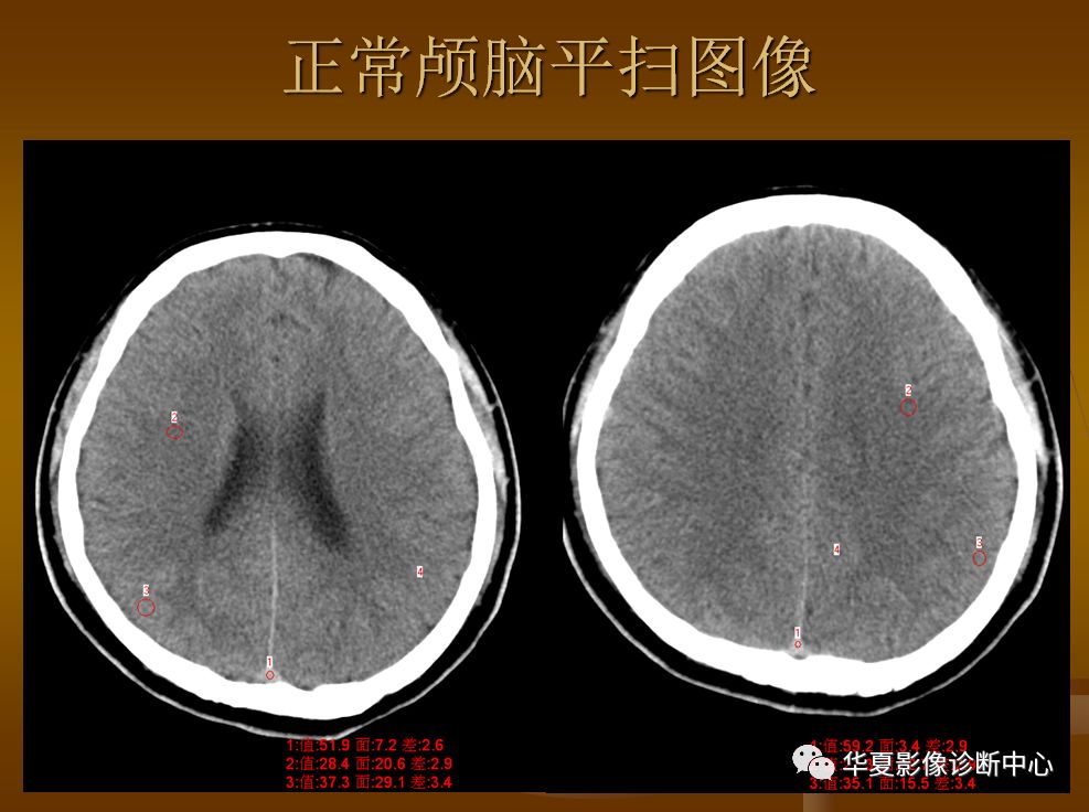 【PPT】脑静脉窦血栓形成的CT诊断
