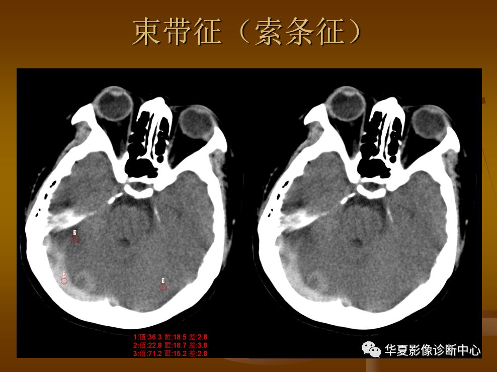 【PPT】脑静脉窦血栓形成的CT诊断