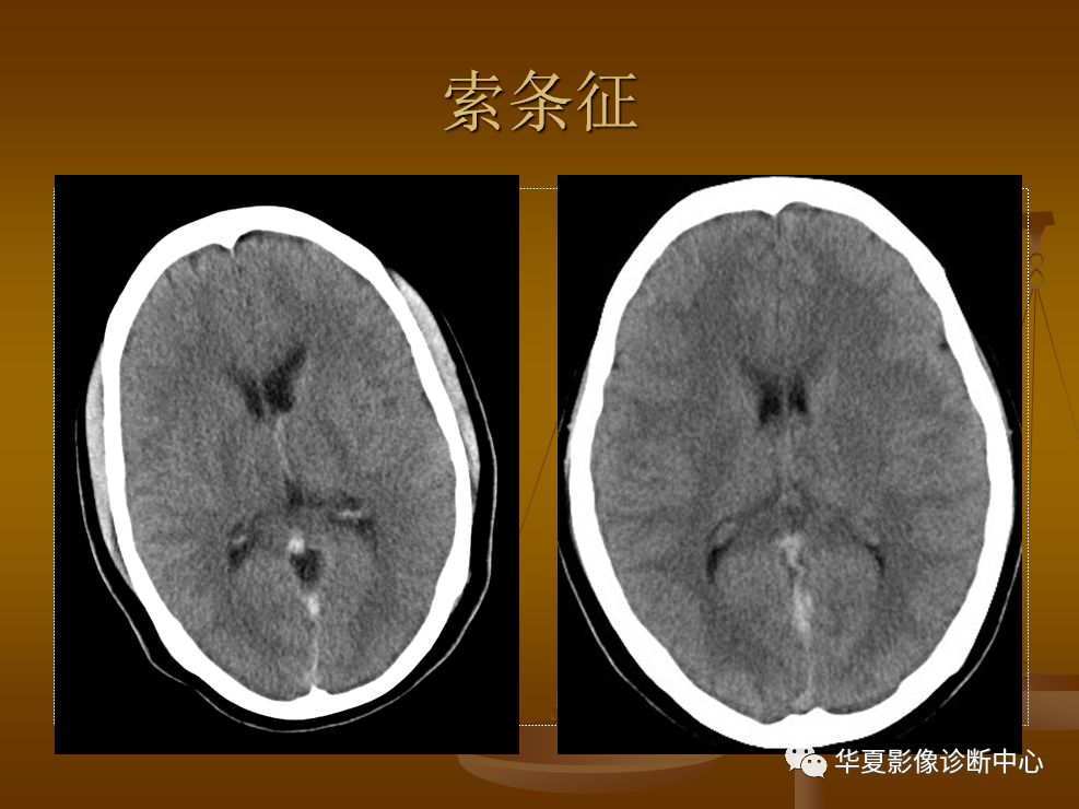 【PPT】脑静脉窦血栓形成的CT诊断
