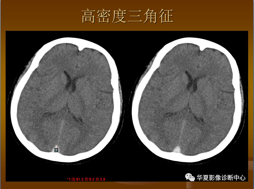 【PPT】脑静脉窦血栓形成的CT诊断