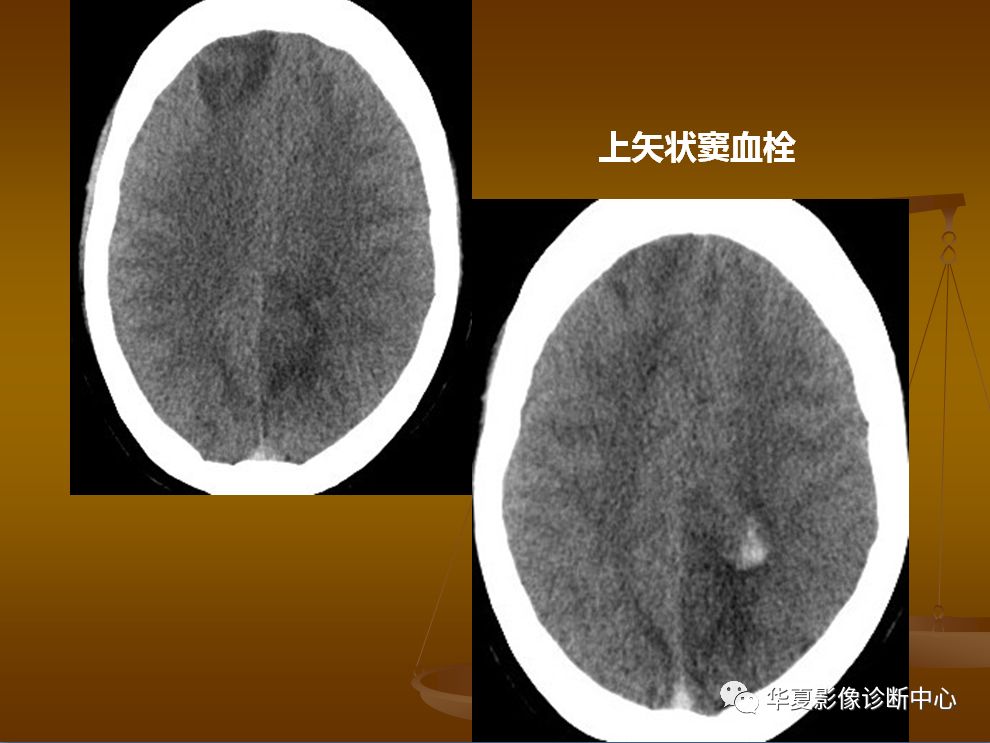 【PPT】脑静脉窦血栓形成的CT诊断
