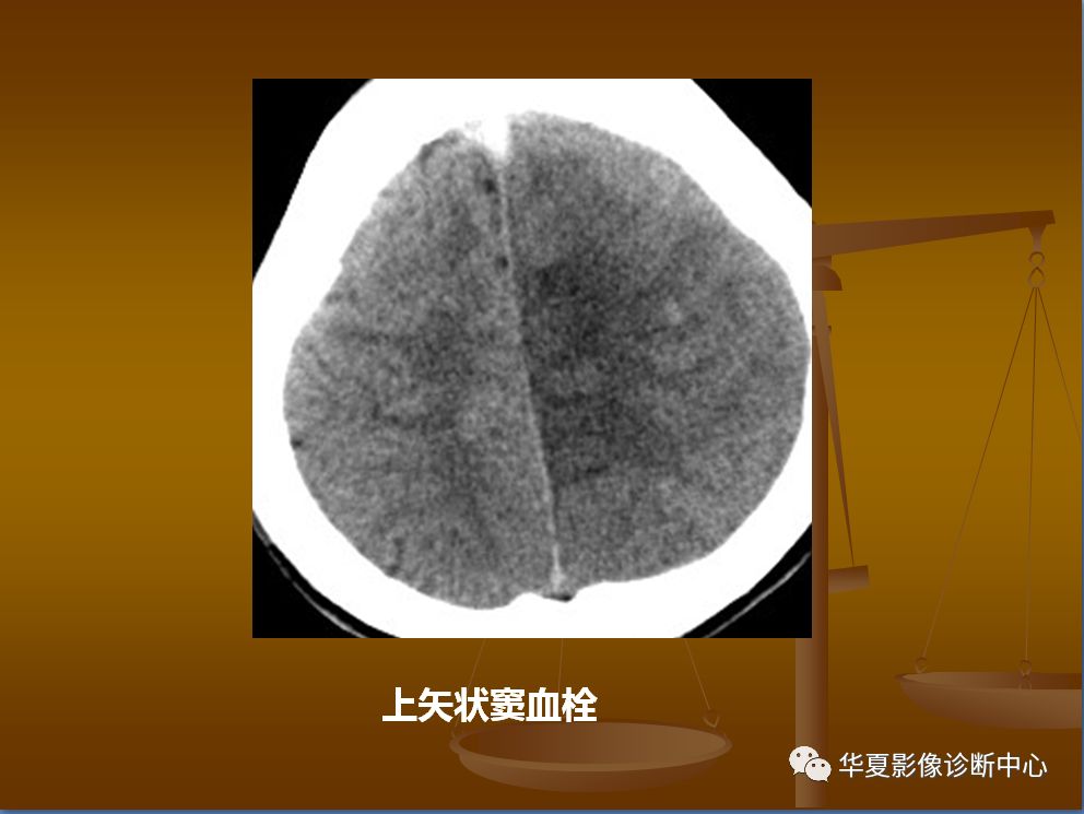 【PPT】脑静脉窦血栓形成的CT诊断