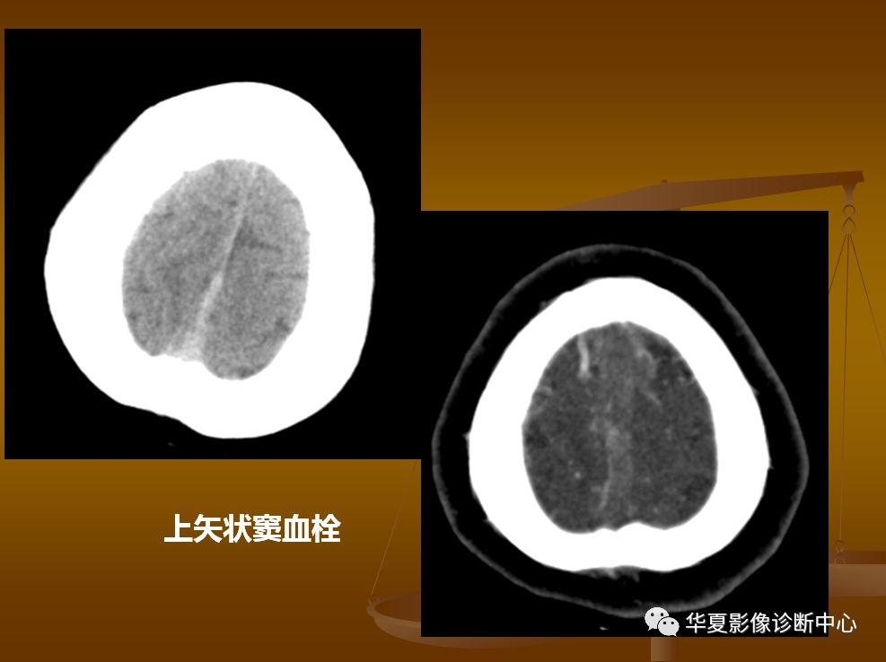 【PPT】脑静脉窦血栓形成的CT诊断