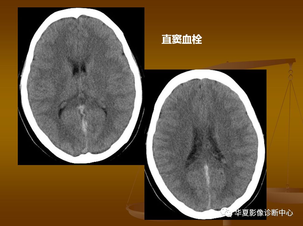 【PPT】脑静脉窦血栓形成的CT诊断