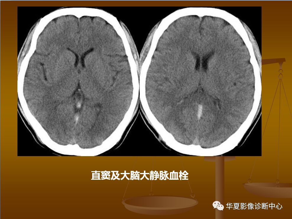 【PPT】脑静脉窦血栓形成的CT诊断