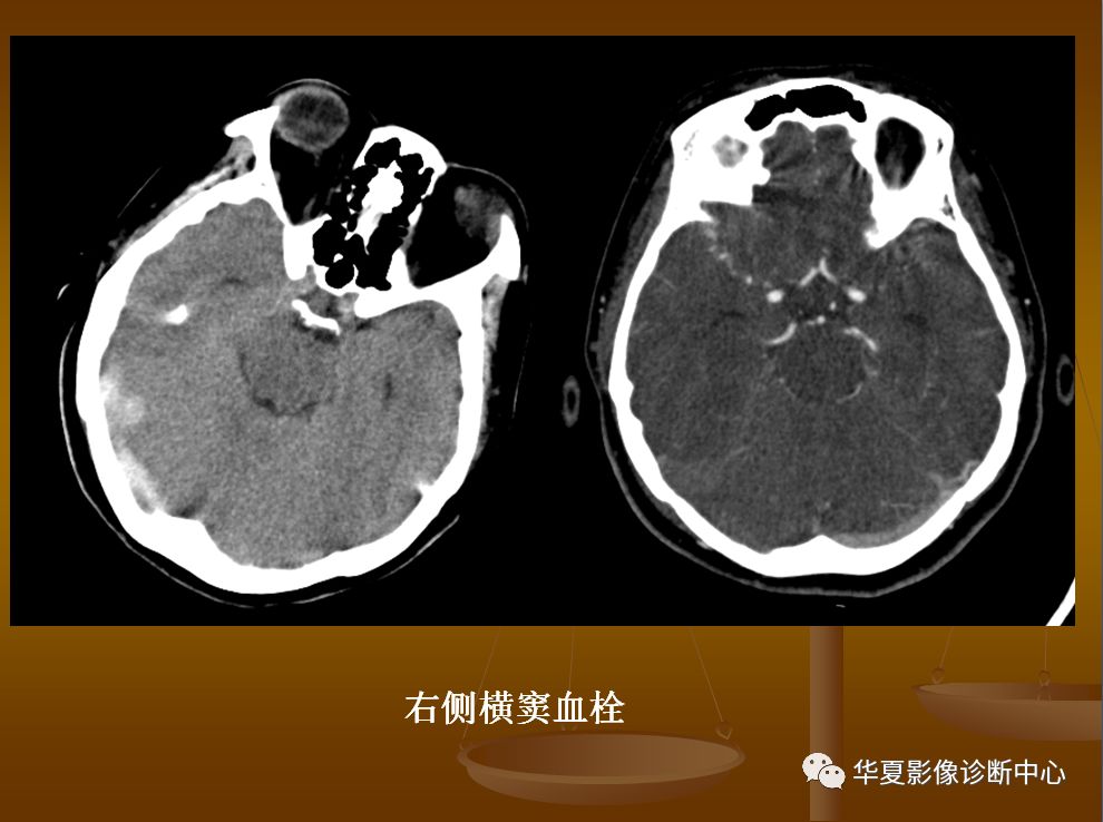 【PPT】脑静脉窦血栓形成的CT诊断