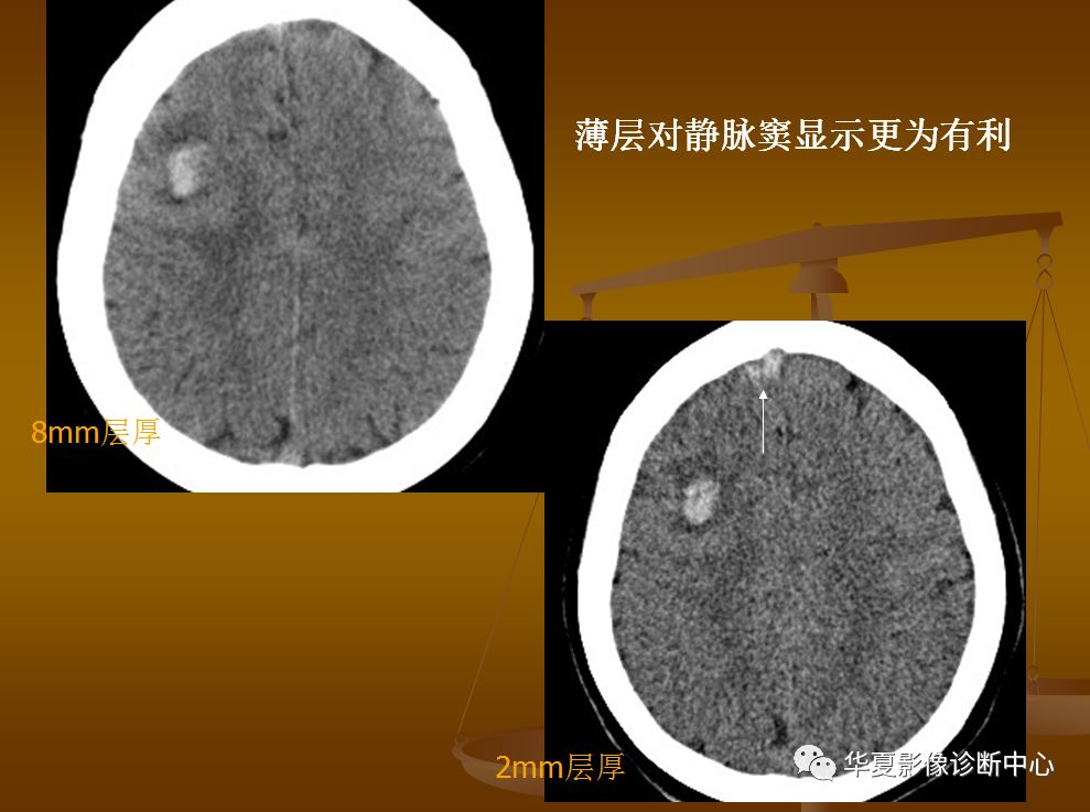 【PPT】脑静脉窦血栓形成的CT诊断