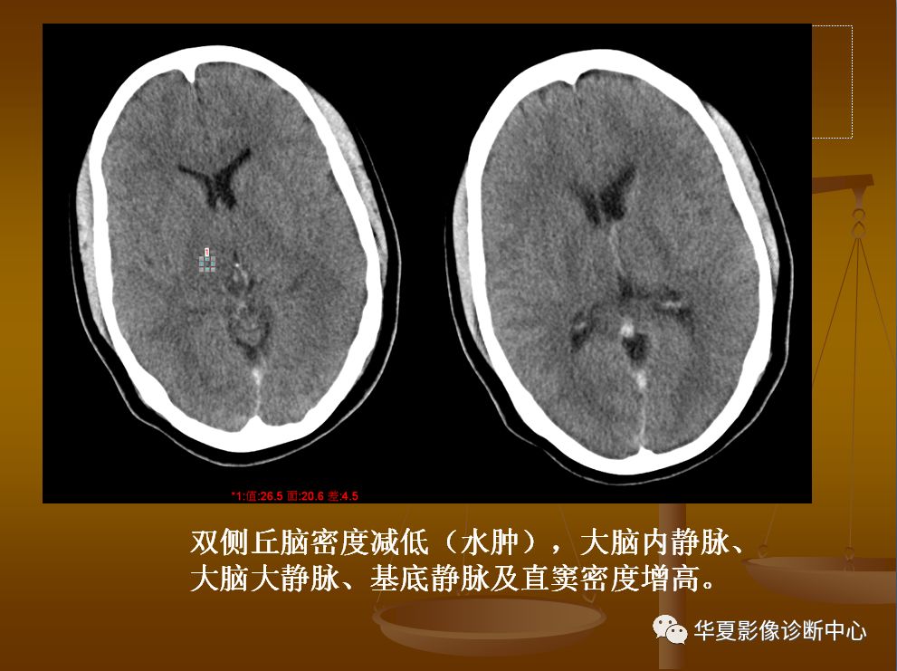 【PPT】脑静脉窦血栓形成的CT诊断