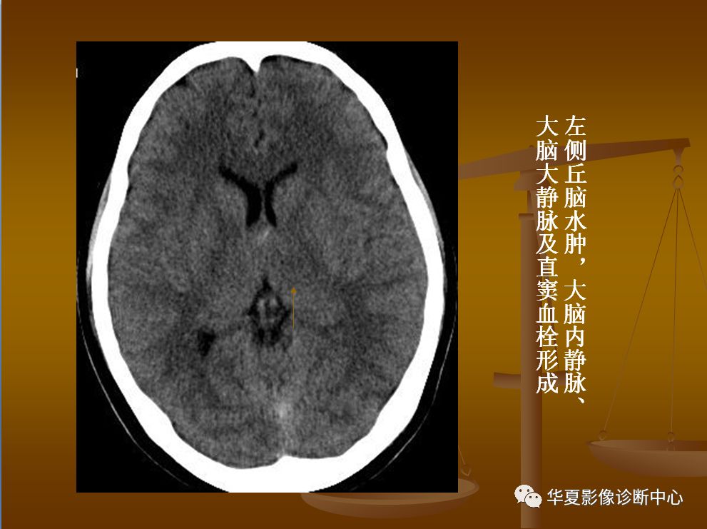 【PPT】脑静脉窦血栓形成的CT诊断