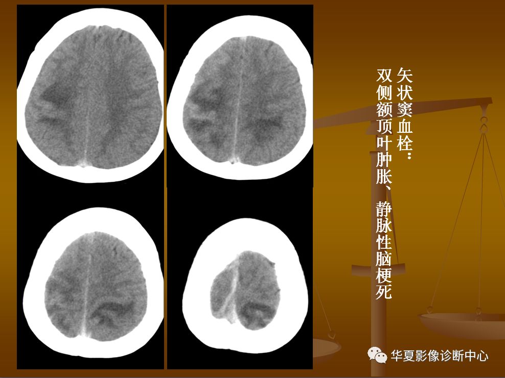 【PPT】脑静脉窦血栓形成的CT诊断