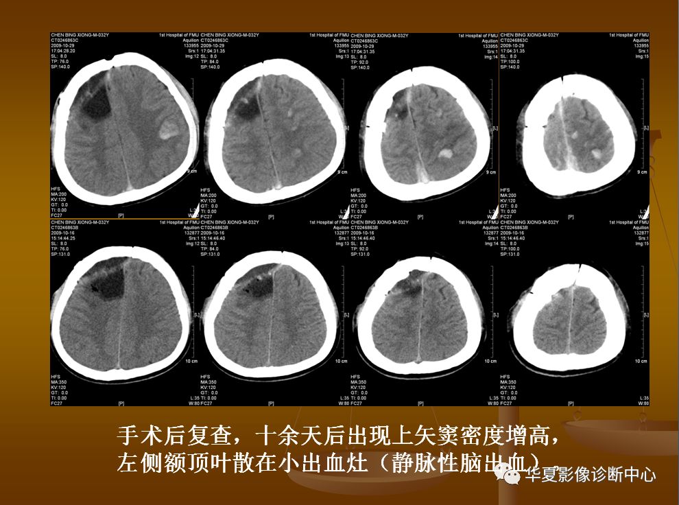 【PPT】脑静脉窦血栓形成的CT诊断