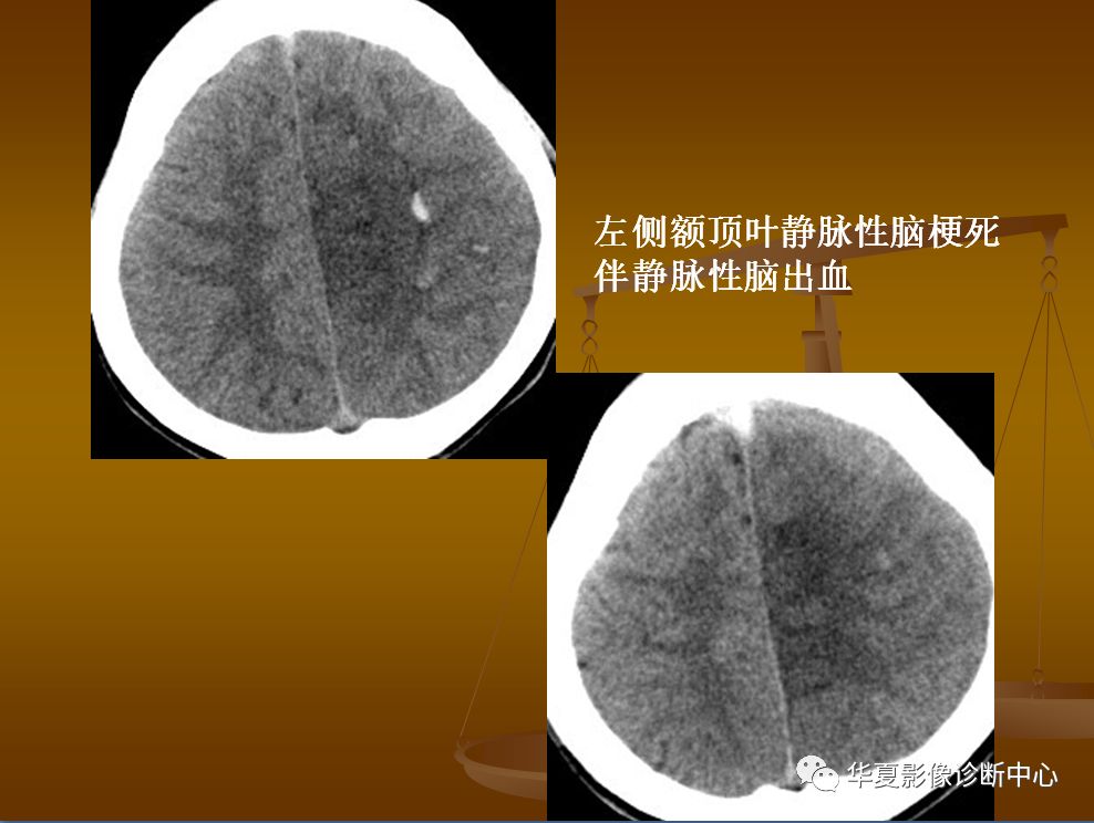 【PPT】脑静脉窦血栓形成的CT诊断