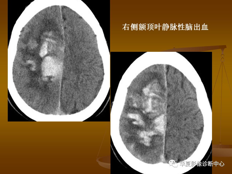 【PPT】脑静脉窦血栓形成的CT诊断