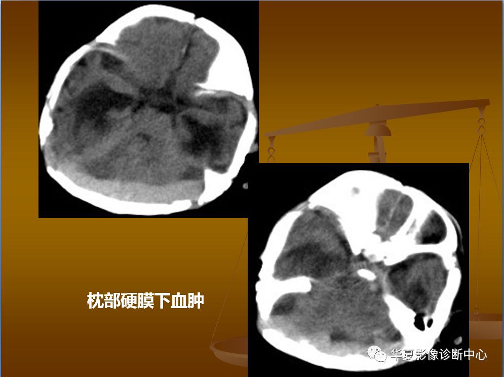 【PPT】脑静脉窦血栓形成的CT诊断