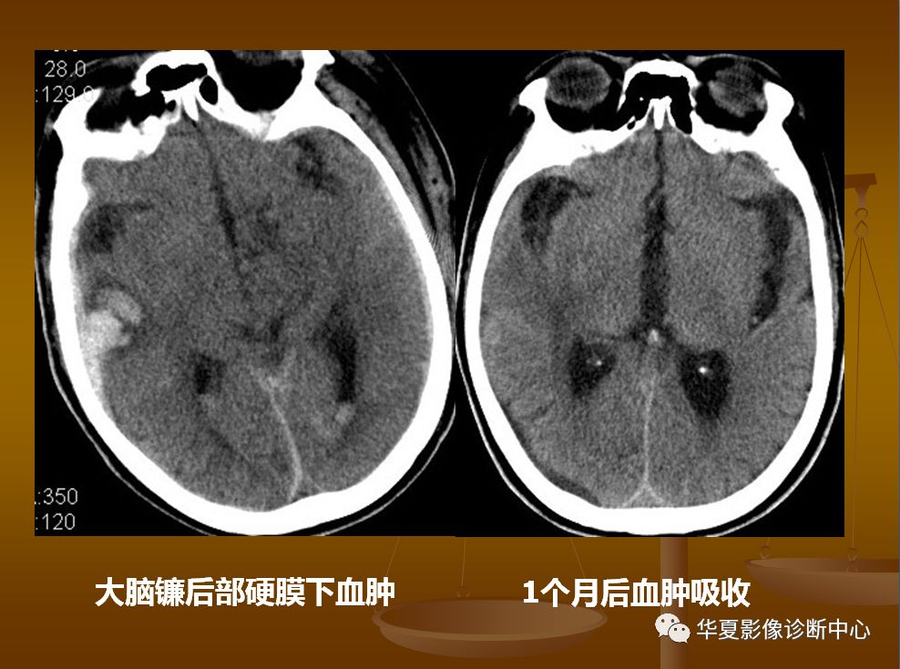 【PPT】脑静脉窦血栓形成的CT诊断