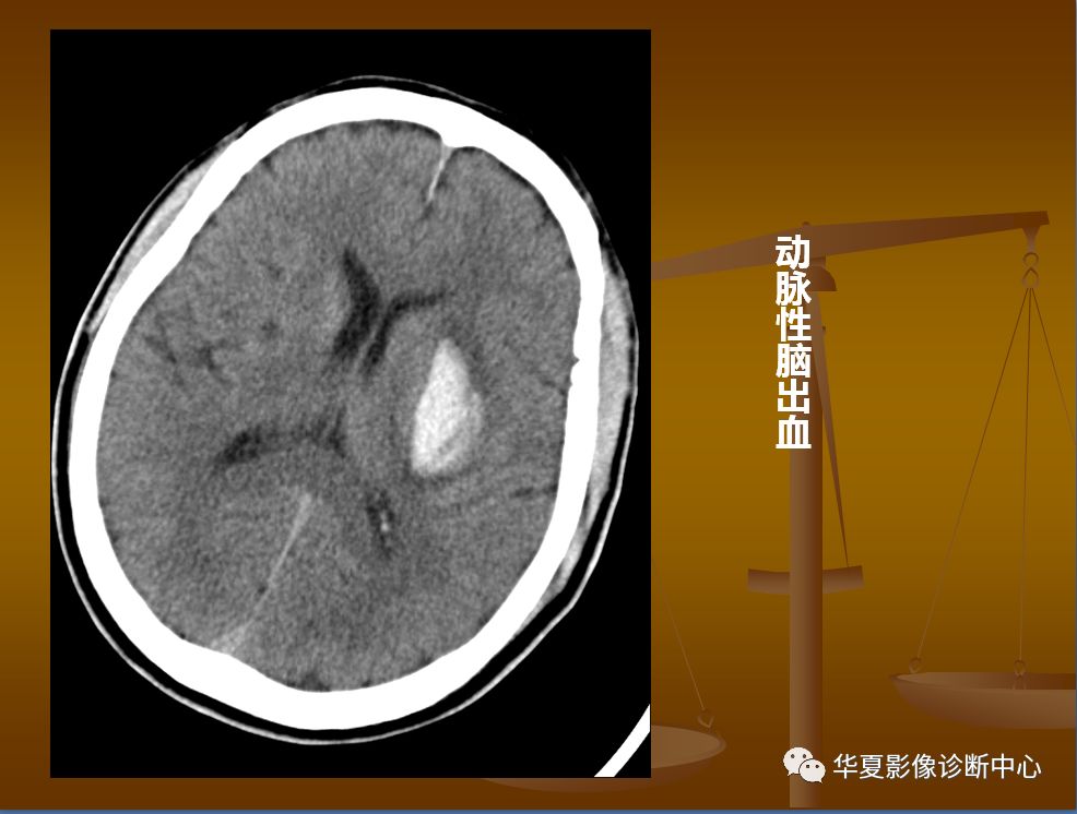 【PPT】脑静脉窦血栓形成的CT诊断