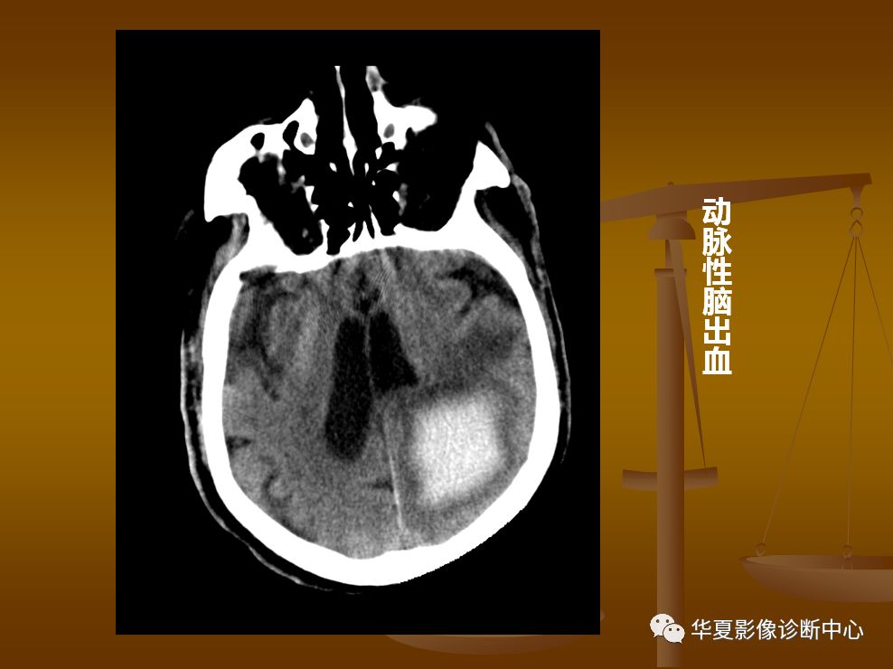 【PPT】脑静脉窦血栓形成的CT诊断