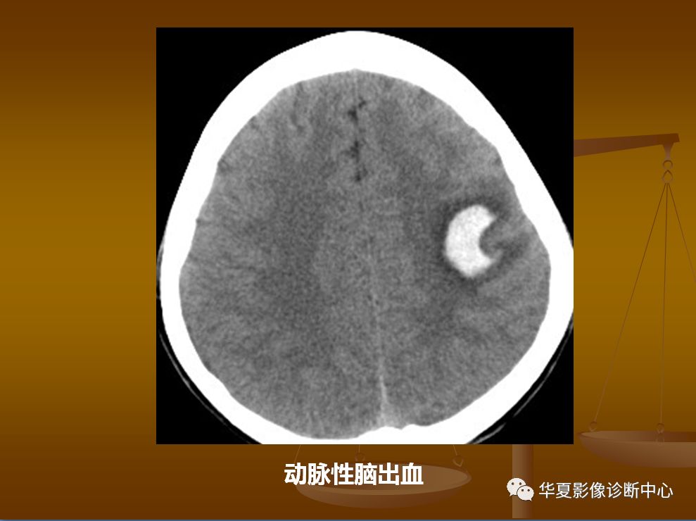 【PPT】脑静脉窦血栓形成的CT诊断