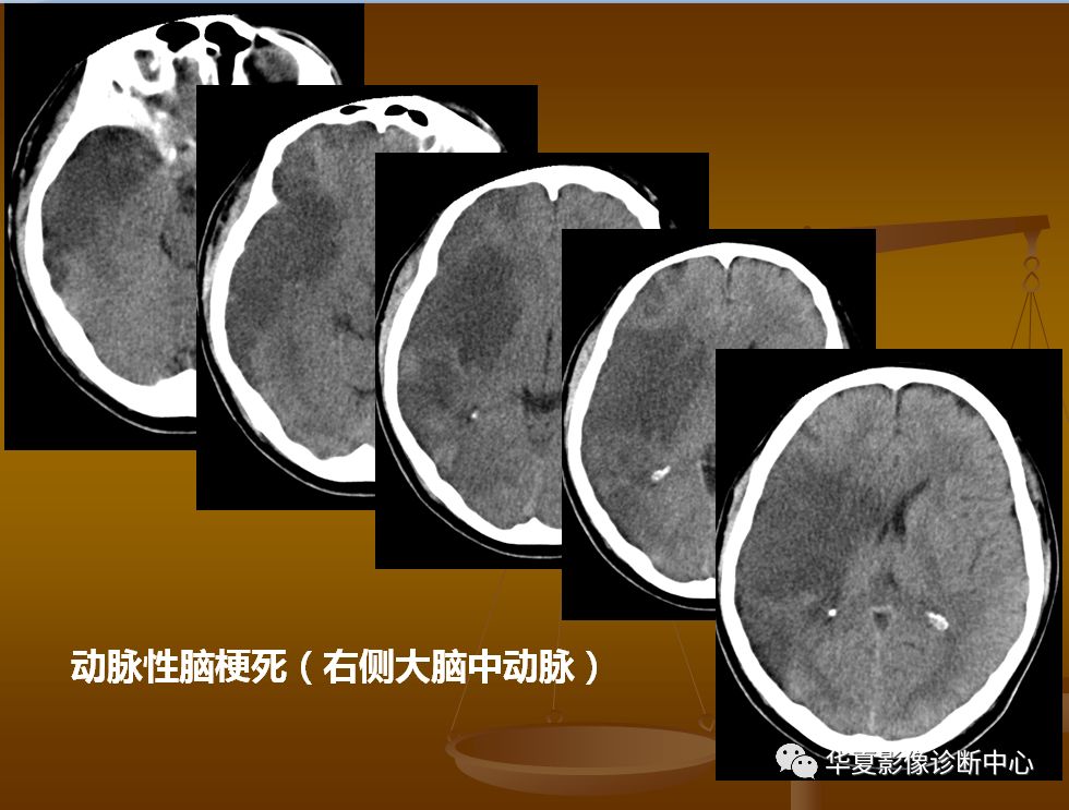 【PPT】脑静脉窦血栓形成的CT诊断