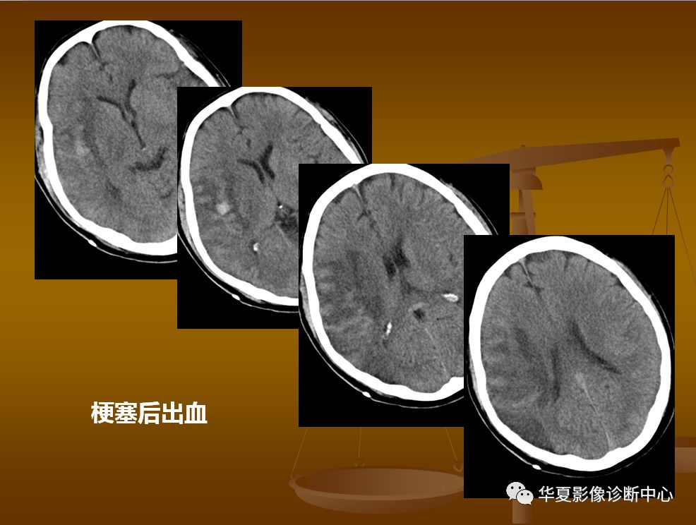 【PPT】脑静脉窦血栓形成的CT诊断
