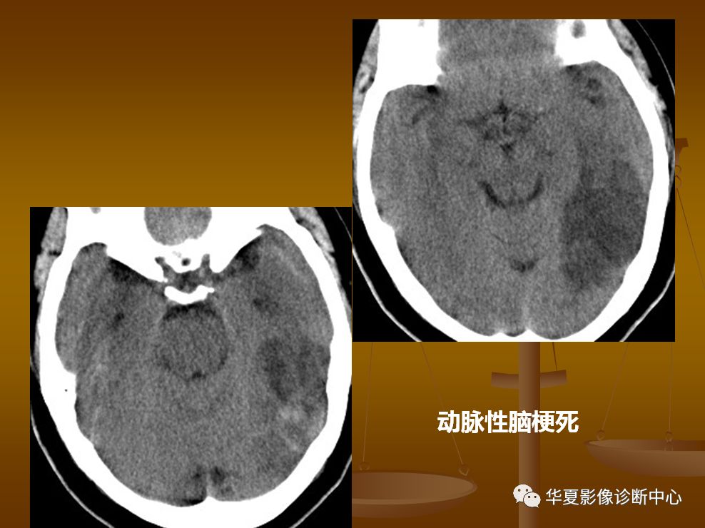 【PPT】脑静脉窦血栓形成的CT诊断