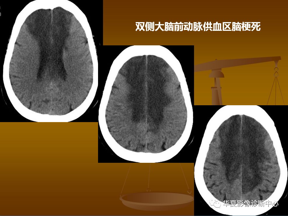 【PPT】脑静脉窦血栓形成的CT诊断