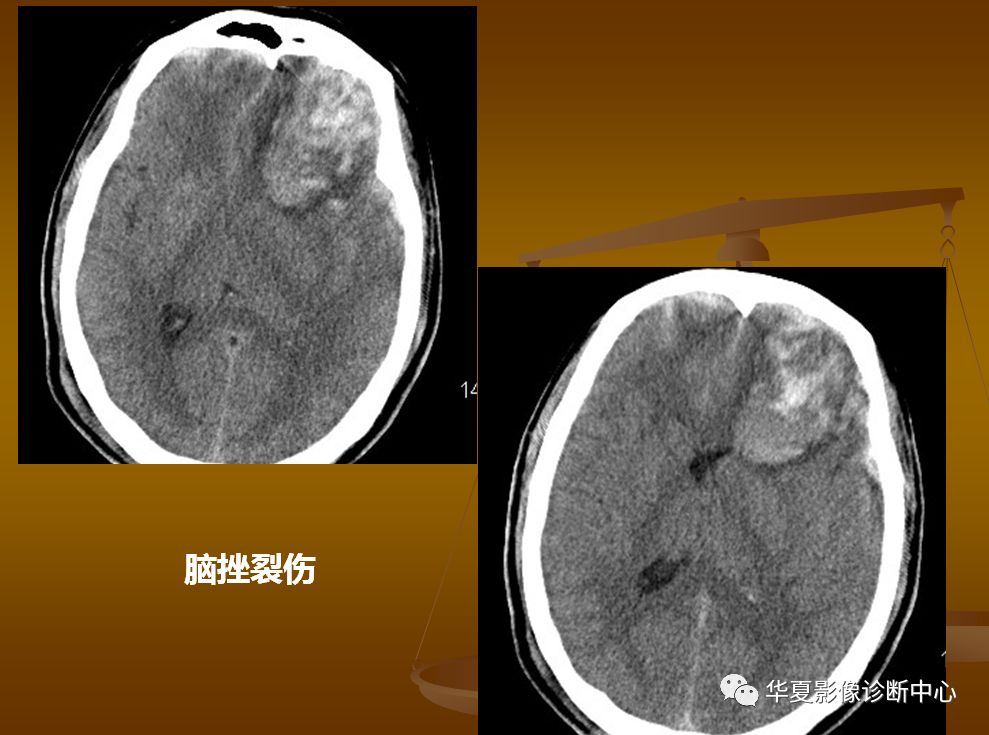 【PPT】脑静脉窦血栓形成的CT诊断
