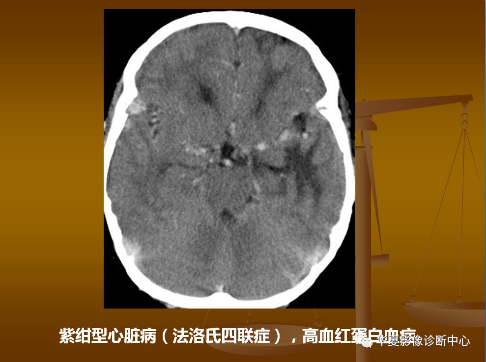 【PPT】脑静脉窦血栓形成的CT诊断