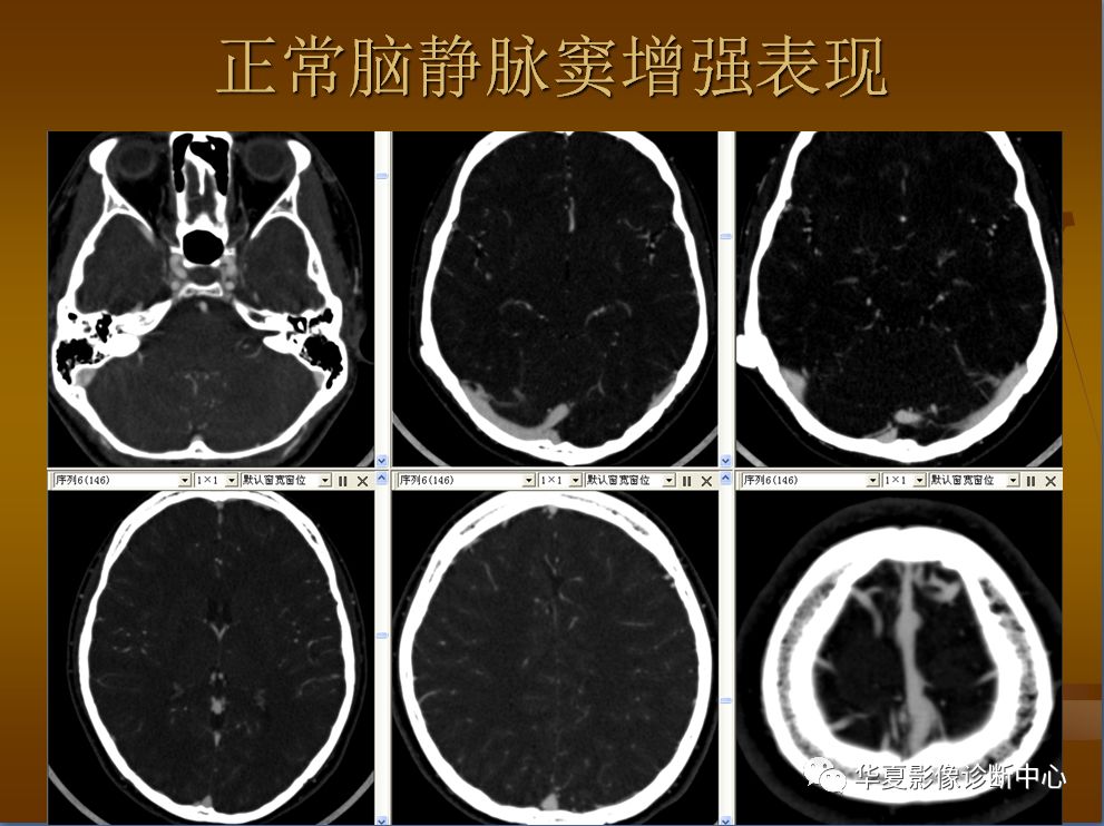 【PPT】脑静脉窦血栓形成的CT诊断