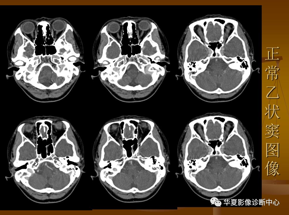 【PPT】脑静脉窦血栓形成的CT诊断