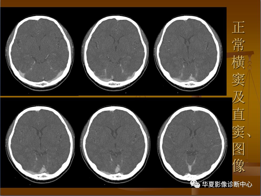 【PPT】脑静脉窦血栓形成的CT诊断