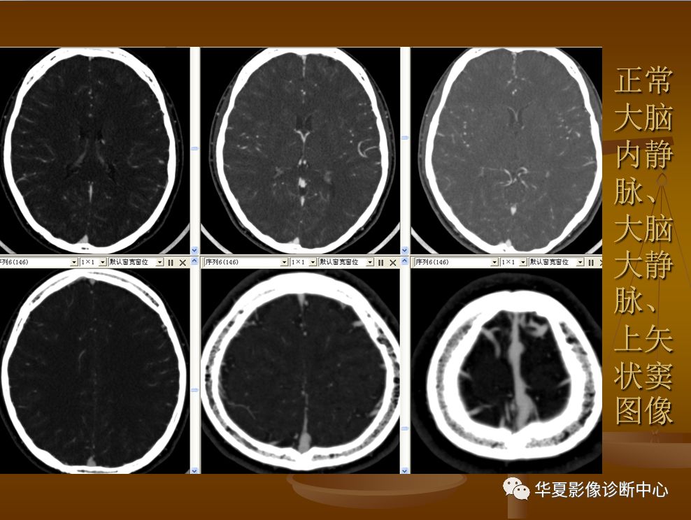 【PPT】脑静脉窦血栓形成的CT诊断