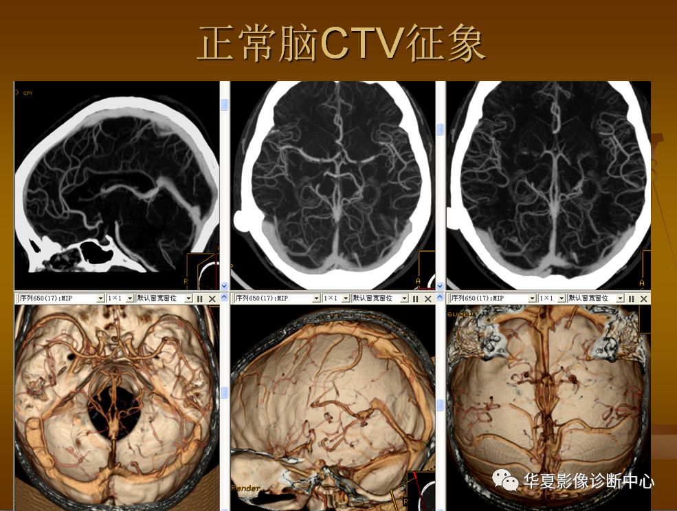 【PPT】脑静脉窦血栓形成的CT诊断