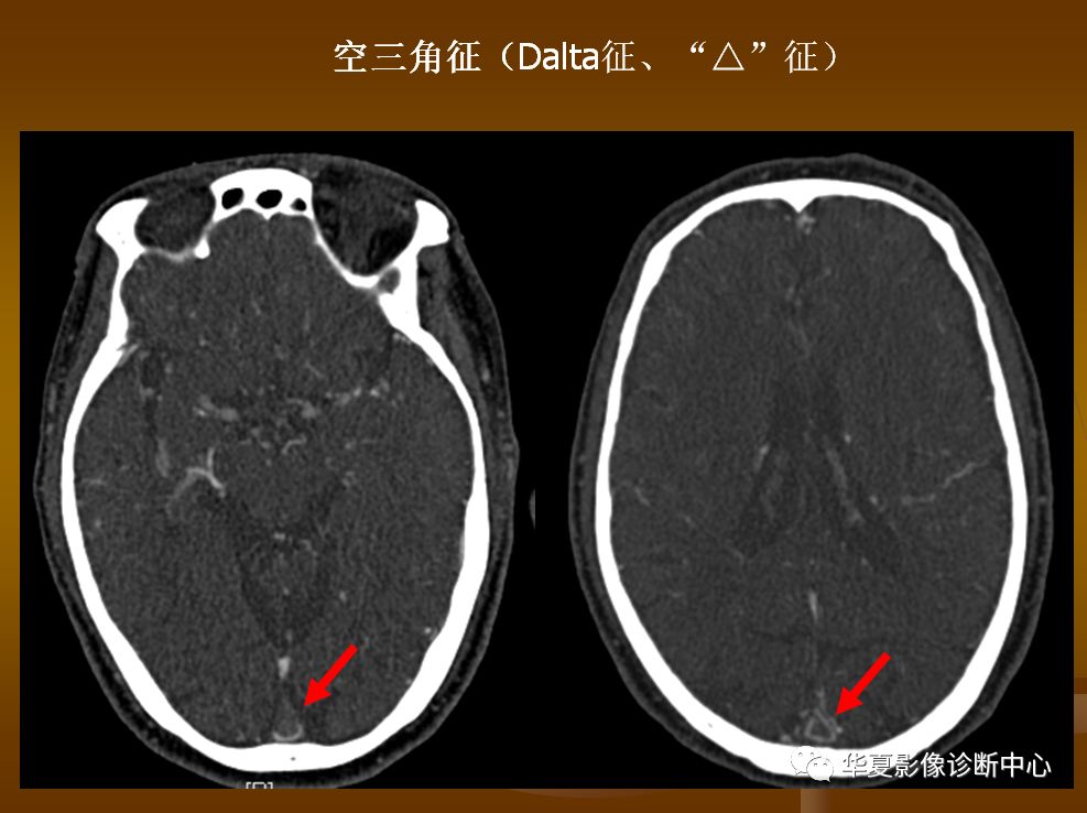【PPT】脑静脉窦血栓形成的CT诊断