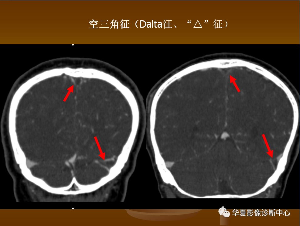 【PPT】脑静脉窦血栓形成的CT诊断