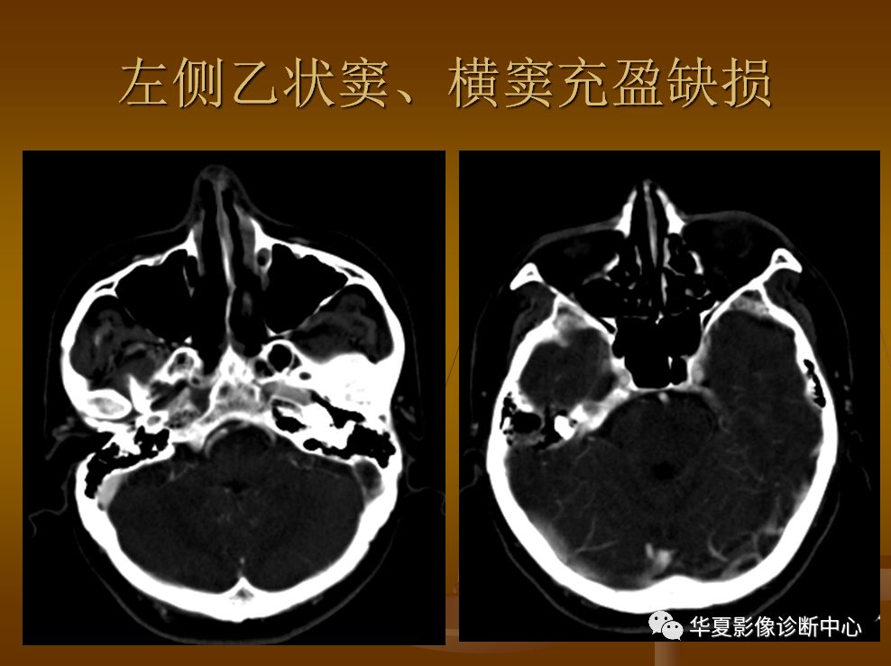 【PPT】脑静脉窦血栓形成的CT诊断