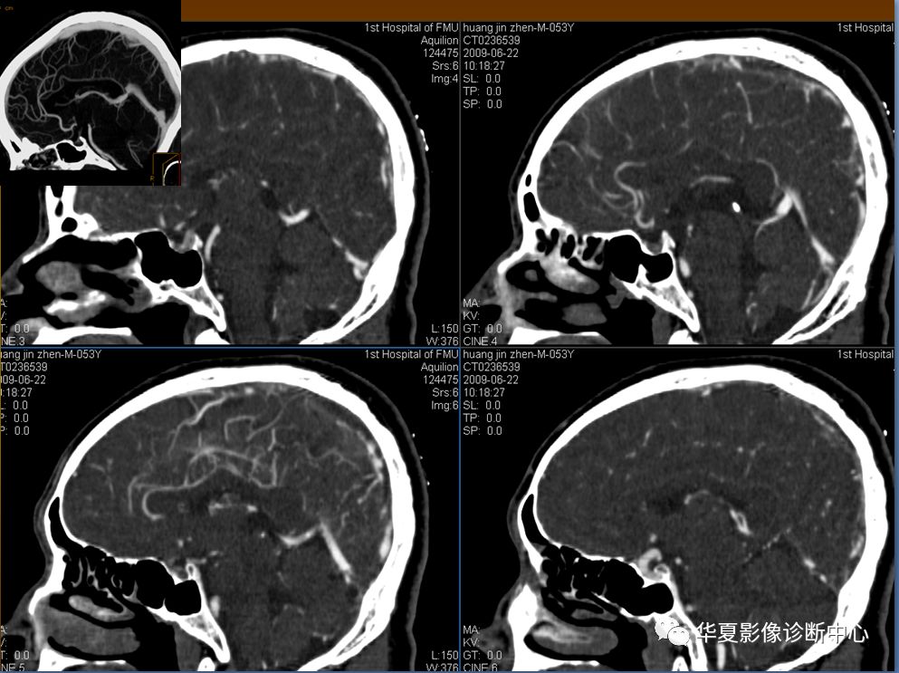 【PPT】脑静脉窦血栓形成的CT诊断