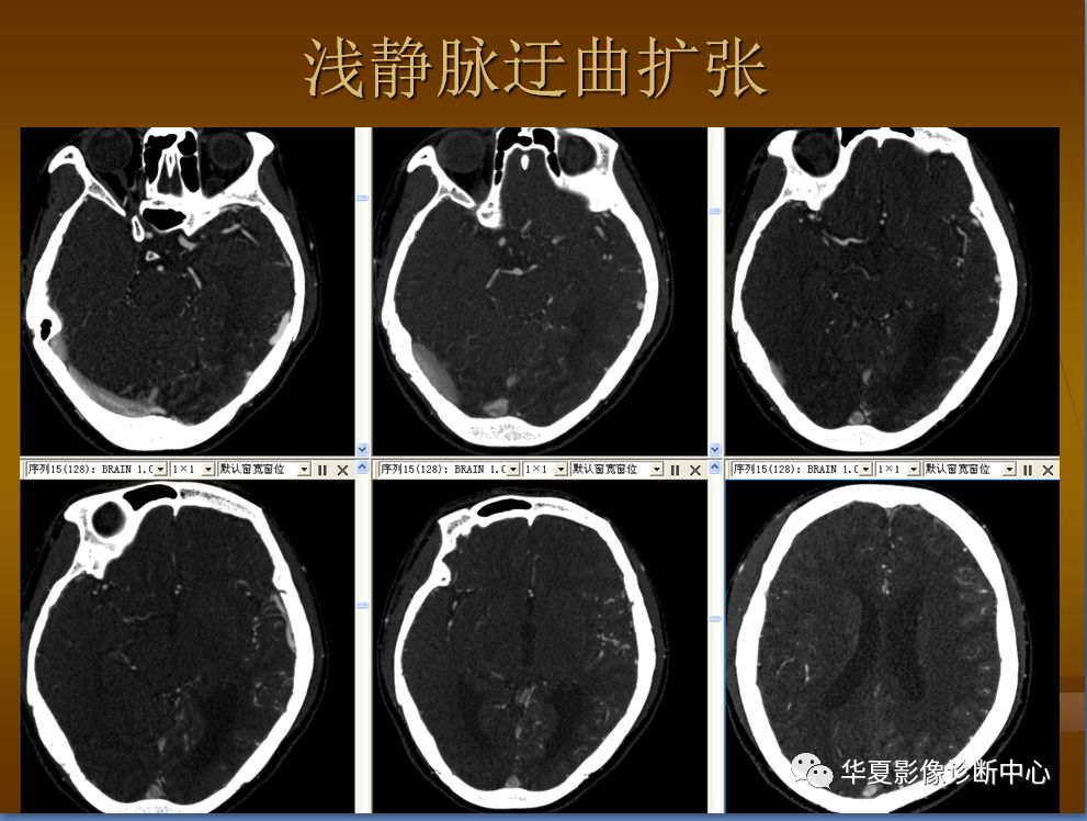 【PPT】脑静脉窦血栓形成的CT诊断