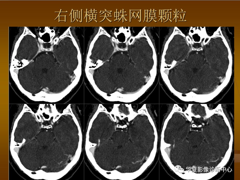 【PPT】脑静脉窦血栓形成的CT诊断