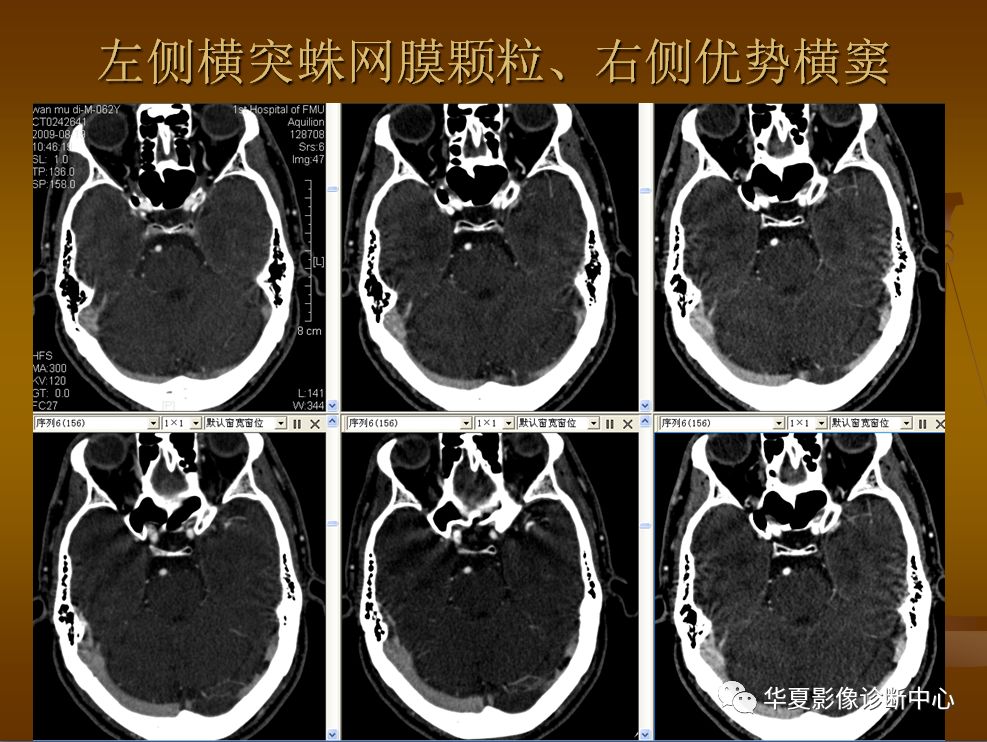 【PPT】脑静脉窦血栓形成的CT诊断