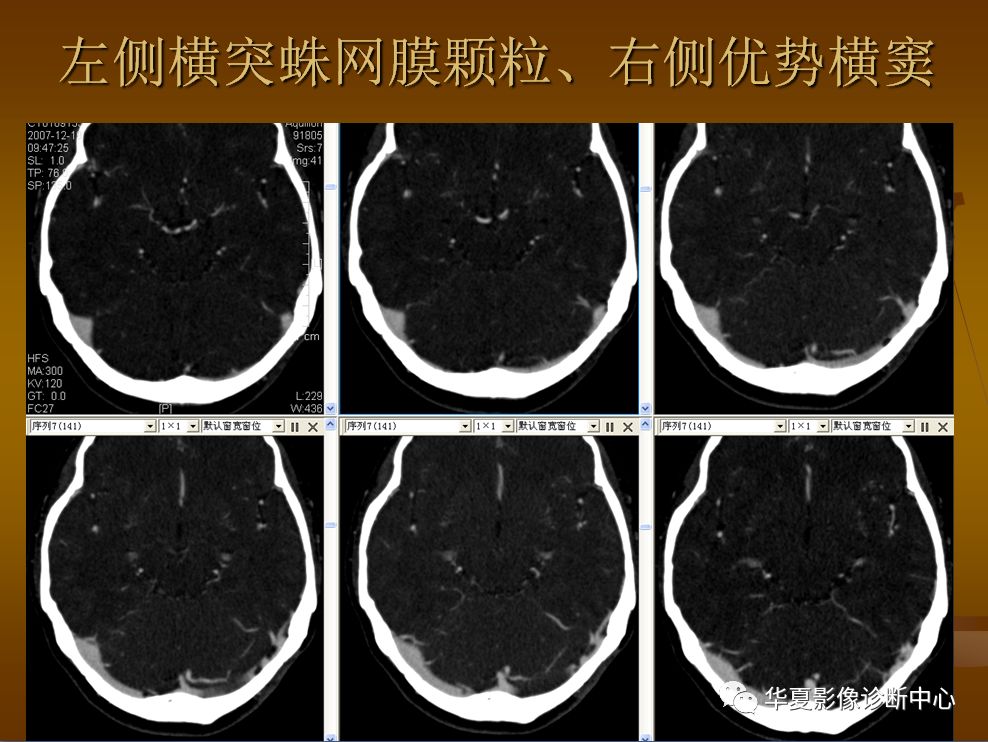 【PPT】脑静脉窦血栓形成的CT诊断