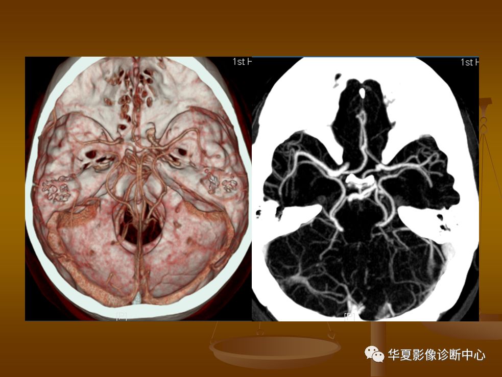 【PPT】脑静脉窦血栓形成的CT诊断