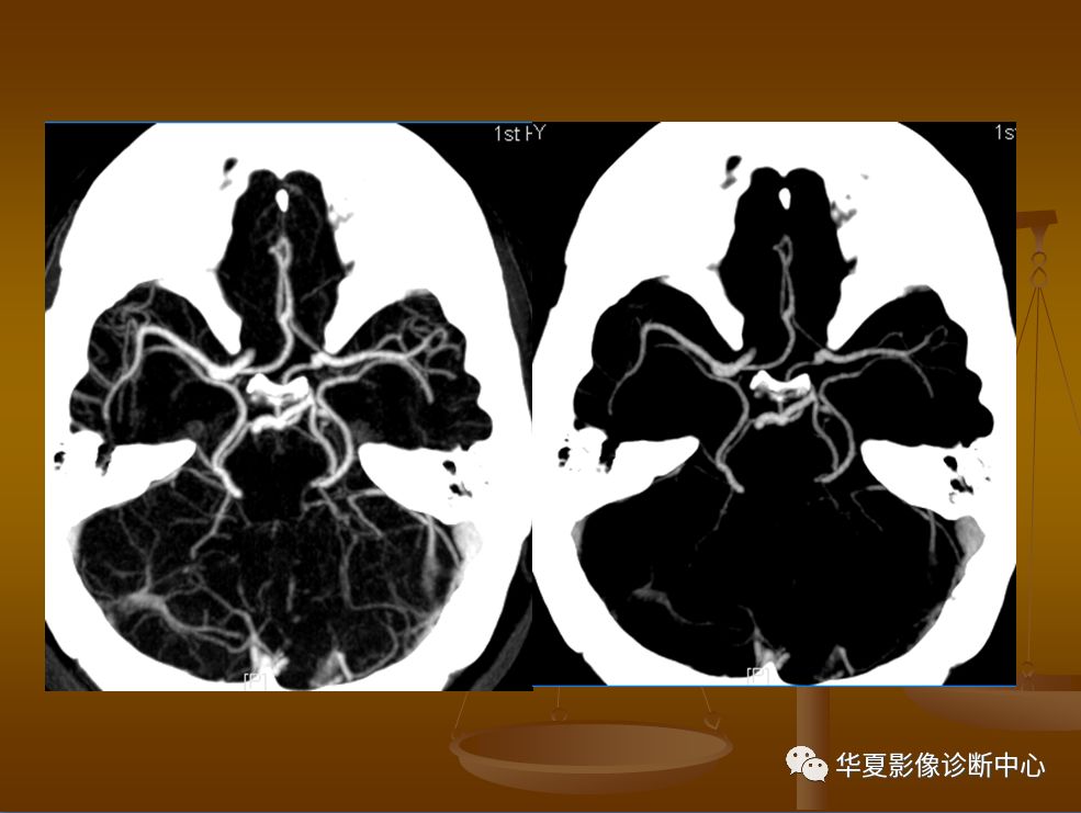 【PPT】脑静脉窦血栓形成的CT诊断