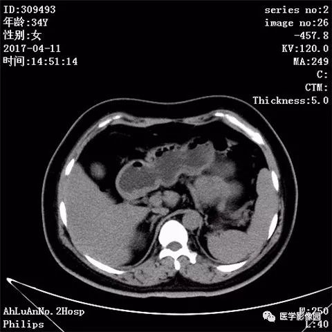 【病例】胰腺实性假乳头状瘤1例CT影像表现 【病例】胰腺实性假乳头状瘤1例CT影像表现